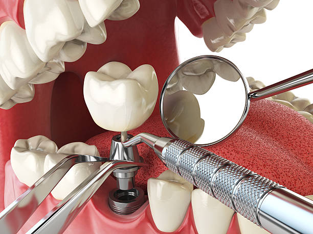 Best Emergency Wisdom Teeth Removal in Murrells Inlet, SC